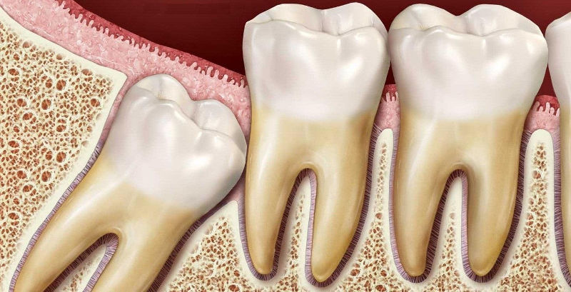 Причины затрудненного прорезывания зуба мудрости