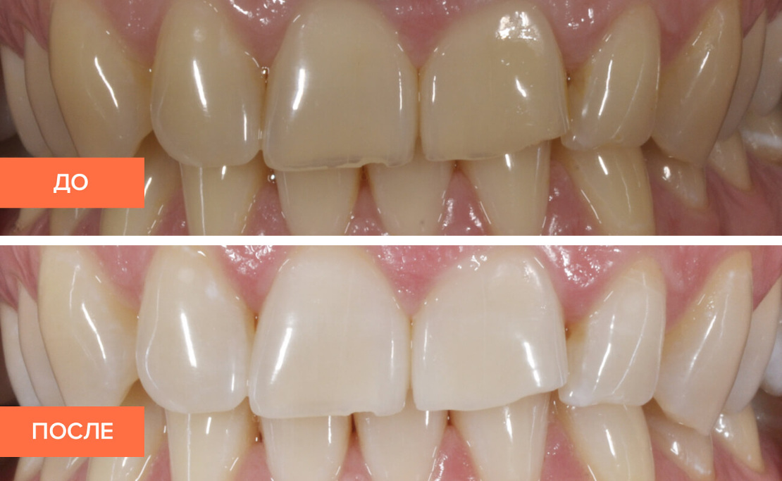 на фото профессиональная чистка зубов в клинике Багита до и после